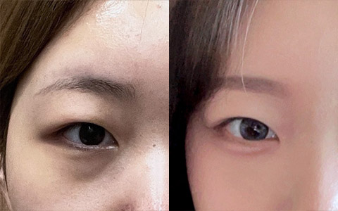 리프팅동안 눈밑지+앞볼지방이식 이미지