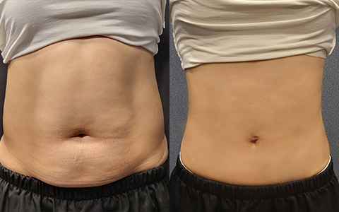 지방흡입 360도 지방흡입(팔,복부) 이미지