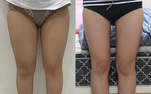 룩팻 룩팻 11병 (허벅지안쪽) 이미지