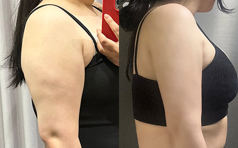 지방흡입 360도 지방흡입(팔) 이미지