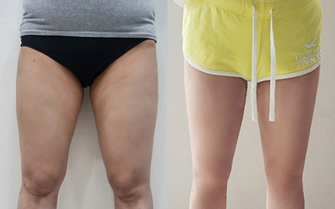 지방흡입 360도 지방흡입(허엉무) 이미지