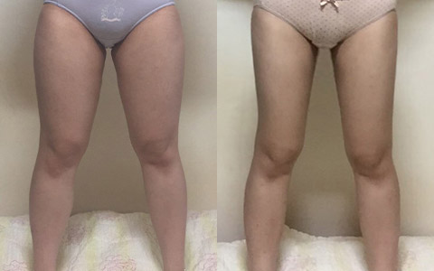 룩팻 룩팻 6병 (허벅지안쪽) 이미지