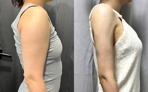 지방흡입 360도 지방흡입 (팔, 복부) 이미지