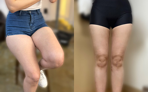 지방흡입 허엉무 지방흡입 이미지