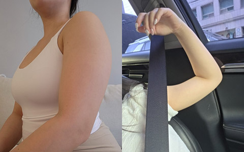 지방흡입 360도 지방흡입 (팔) 이미지