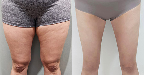 지방흡입 360도 지방흡입(허엉무) 이미지