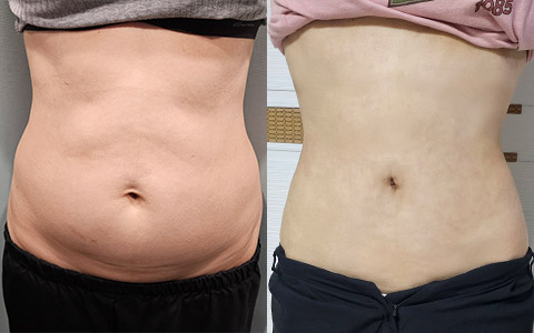 지방흡입 360도 지방흡입(복부) 이미지