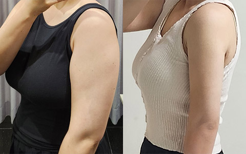 지방흡입 360도 지방흡입 (팔뚝) 이미지