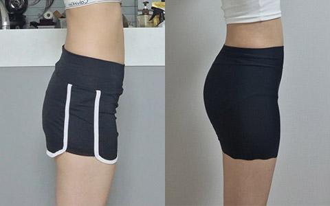 지방흡입 허핏볼업 이미지