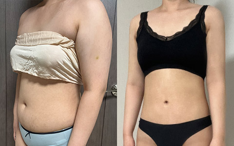 지방흡입 360도 지방흡입(팔, 복부) 이미지