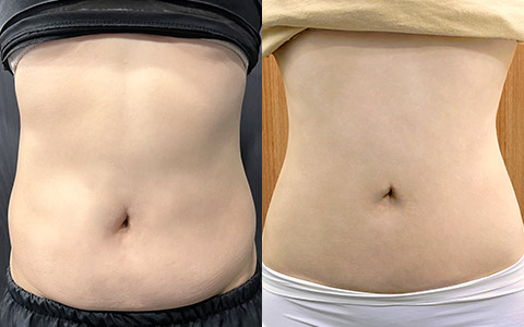 지방흡입 360도 지방흡입(복부) 이미지