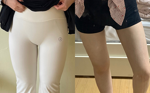 지방흡입 360도 지방흡입 (허엉무) 이미지