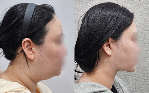 리프팅동안 아큐V윤곽술 이미지