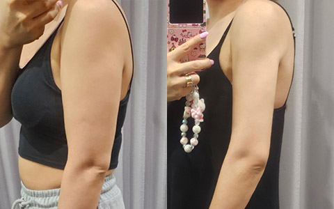 지방흡입 360도 지방흡입 (팔뚝) 이미지