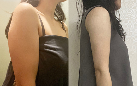 지방흡입 퀵바비라인 (팔뚝) 이미지