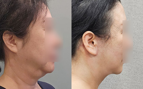 리프팅동안 안면거상술 이미지