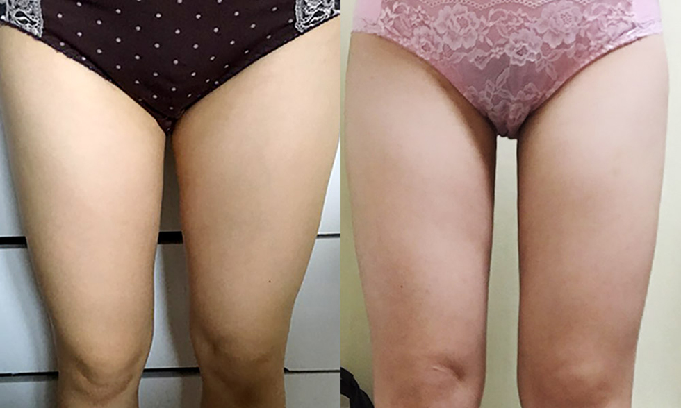 最受欢迎的抽脂手术 No.2 大腿内侧전후사진