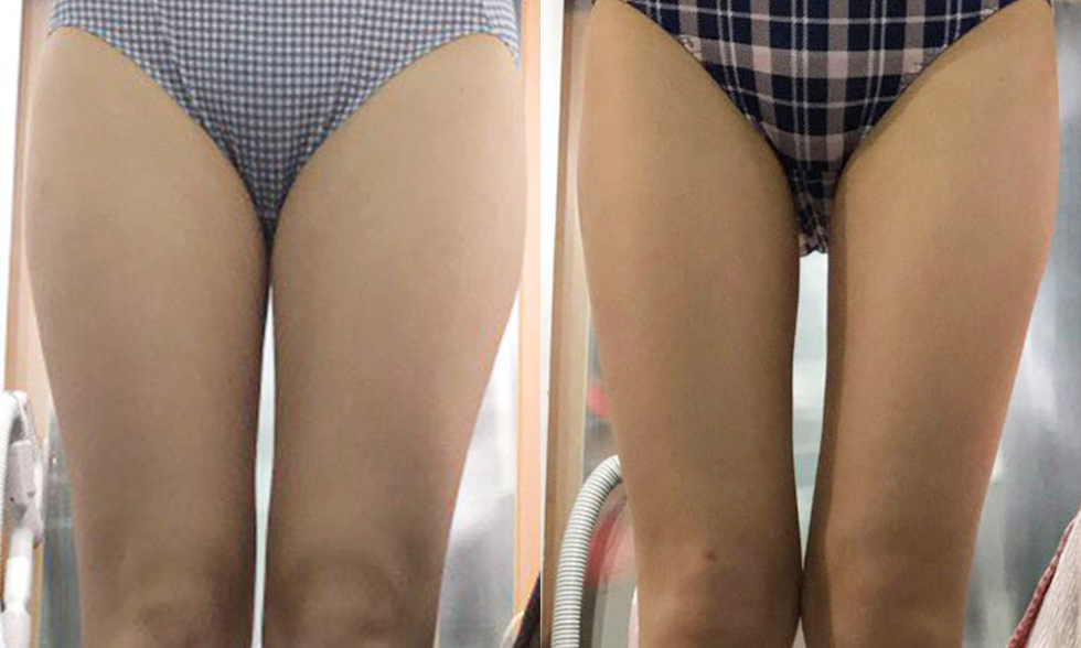最受欢迎的抽脂手术 No.2 大腿内侧전후사진