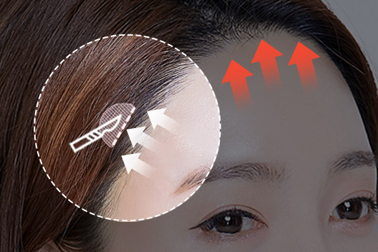 STEP 01 额头皱纹, 眼型下垂