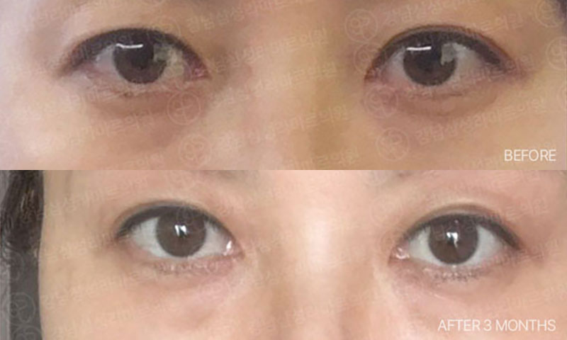 挙上 前後の写真