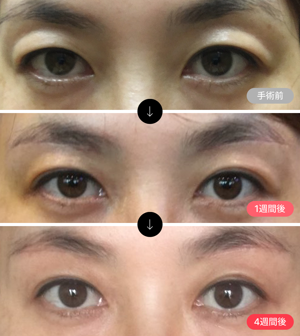 眉毛挙上術, 傷跡がご 心配になりますか？ 直接目で確認してください! 眉毛挙上術実際の施術を受けた患者さんの 抜糸除去直後の姿です。 眉毛のラインを沿って微細切開するため抜糸除去後傷跡があまり 目立たなく、一定時間経過後切開部位が 徐々に薄くなって目に見えないくらい 傷跡が回復する過程を確認できます。