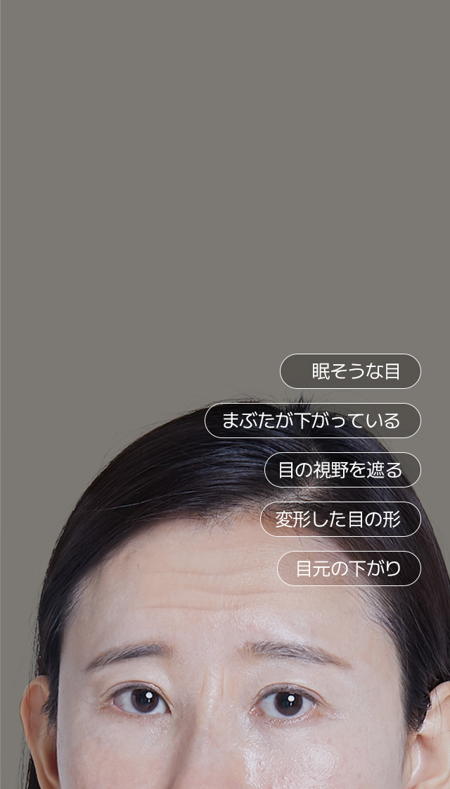 眉毛挙上術で 生き生きとして 若かえる目元！ +老化によるまぶたのたるみ +変形した目の形 +酷いまぶたのたるみで 重苦しい印象 一気に引き上げる！ 眉毛挙上術
