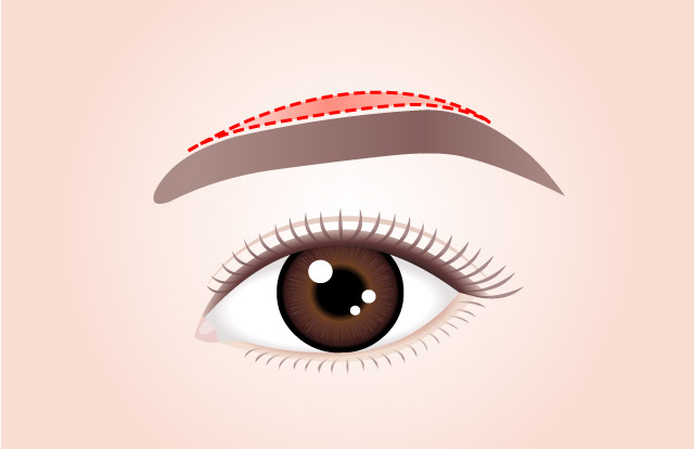 STEP 01 眉毛の上の部分を眉毛のラインを沿って切開