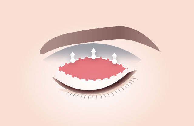 セイイエス眉毛挙上術 皮膚だけ引っ張るのではなく、眼輪筋を引っ張っ て矯正するので 再発可能性減らす↓