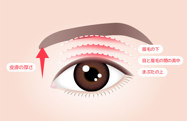 セイイエス眉毛挙上術 セイイエスは皮膚の厚さやたるみの程度を 正確に把握して美的な部分と機能的な 部分全部改善できる手術法を適用