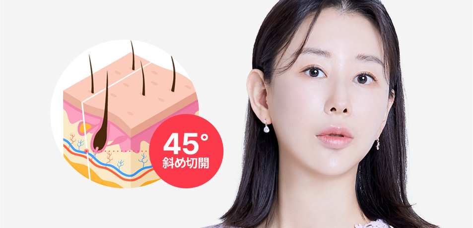 45度斜め切開 毛根を避けて斜めに切開で手術して脱毛及び毛根損傷を予防します。