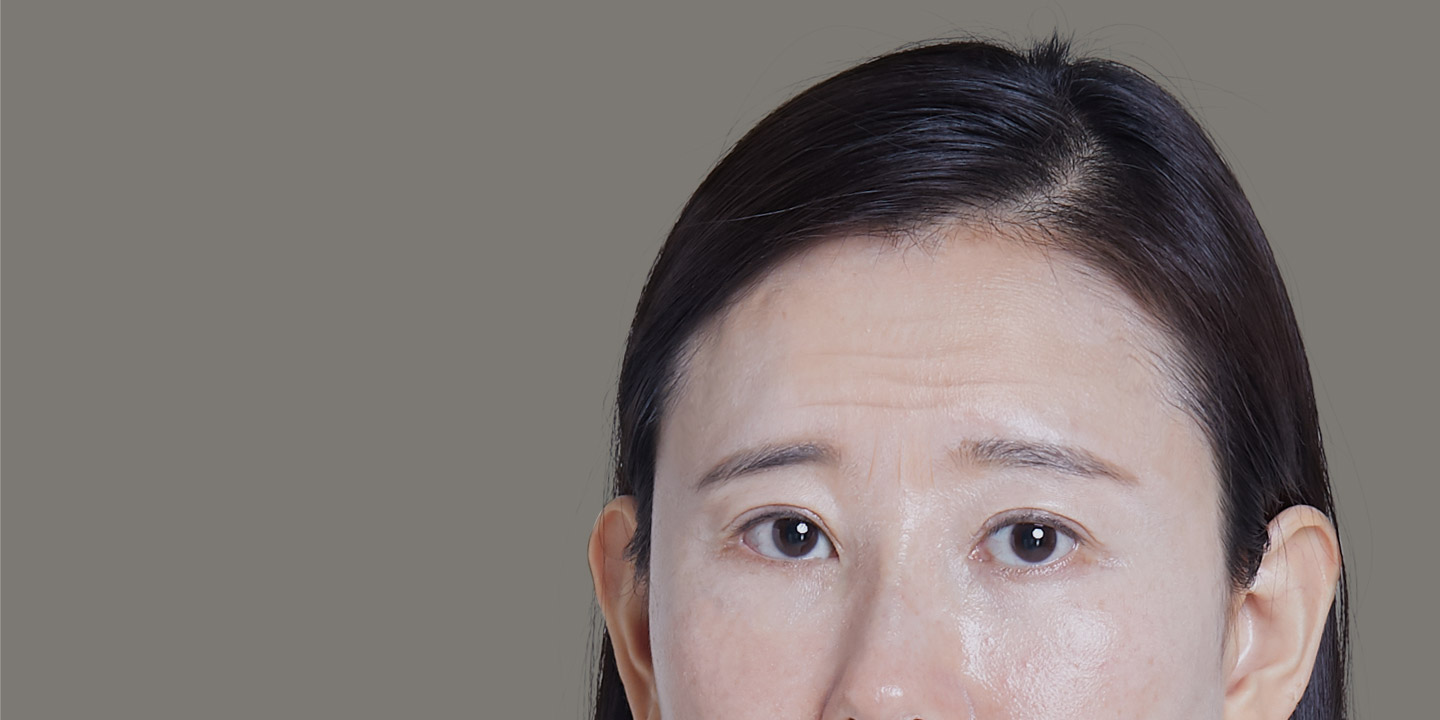 憂鬱に見える 老けて見える + 目元のたるみ + 眉毛のたるみ + 眉間 + 額のしわまで 同時に改善 内視鏡額リフト