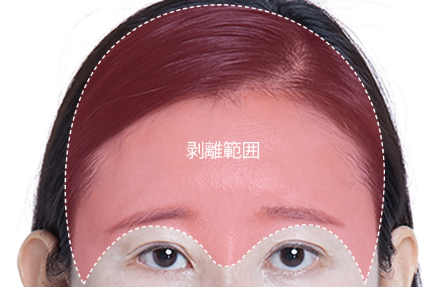 STEP 01 デザイン 個人の老化状態。皮膚組織　しわ方向、 たるみの程度によって 整形プランを立ててデザインを行います。