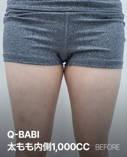 ０２．完璧BABI LINE ＃吸引部位は大容量で～ ＃一般ミニ脂吸2倍以上の脂肪量 ＃2回は無い1回で終わり！