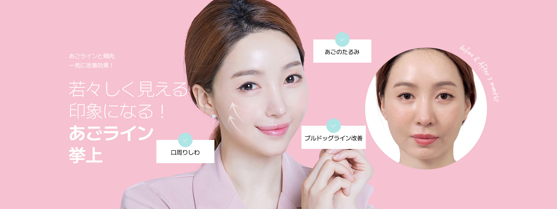 あごラインと頬肉 一気に改善効果！ 若々しく見える 印象になる！ あごライン挙上 口周りしわ あごのたるみ ブルドッグライン改善