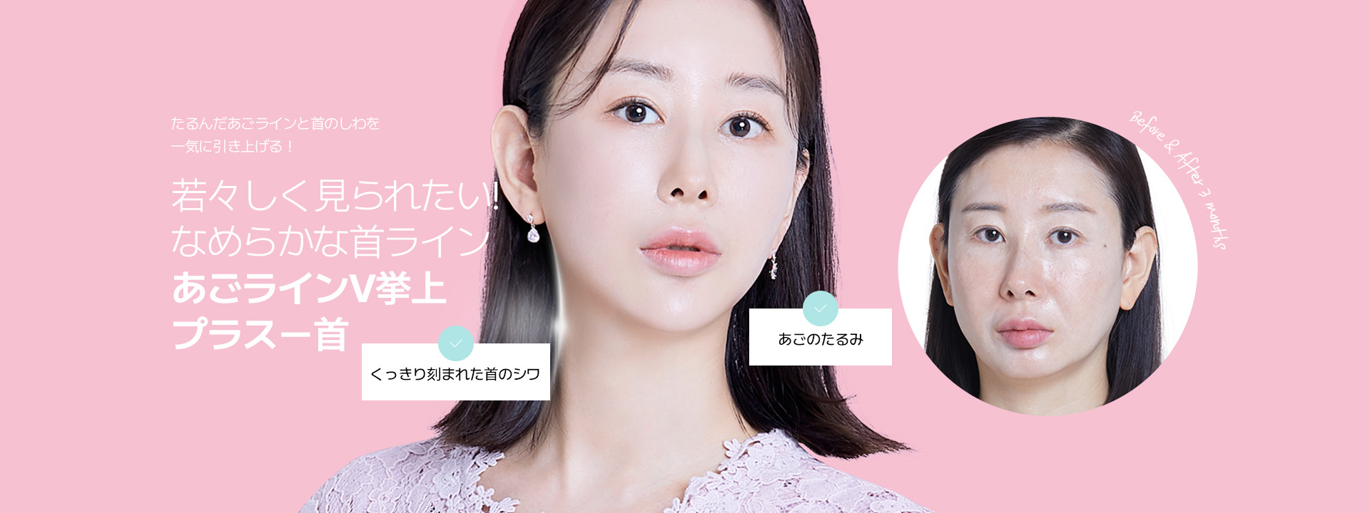 たるんだあごラインと首のしわを 一気に引き上げる！ 若々しく見られたい！ なめらかな首ライン あごラインV挙上 プラスー首 くっきり刻まれた首のシワ あごのたるみ