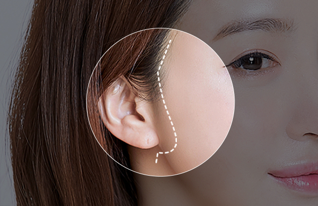 POINT 01 ヘアライン内側の切開で目立ちにくい傷跡