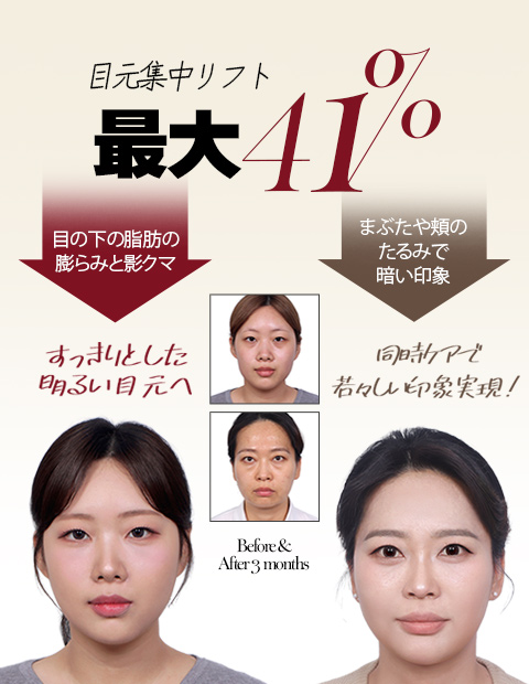 目元集中リフト