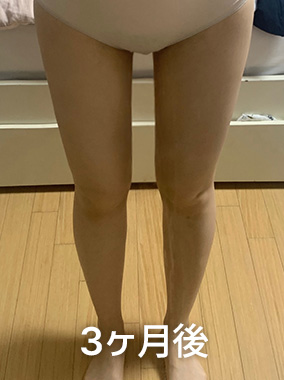 太もも脂肪吸引