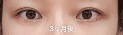 눈가리프팅 전후사진