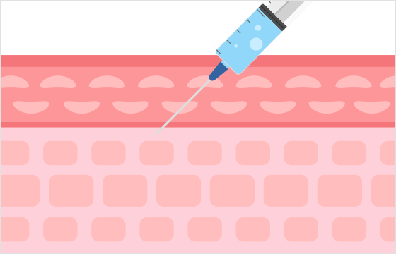 真皮層にスキンバイブを注入