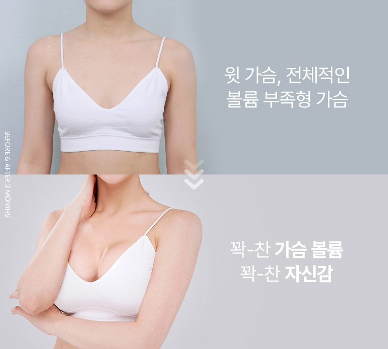 윗 가슴, 전체적인 볼륨 부족형 가슴. 꽉-찬 가슴 볼륨 꽉-찬 자신감