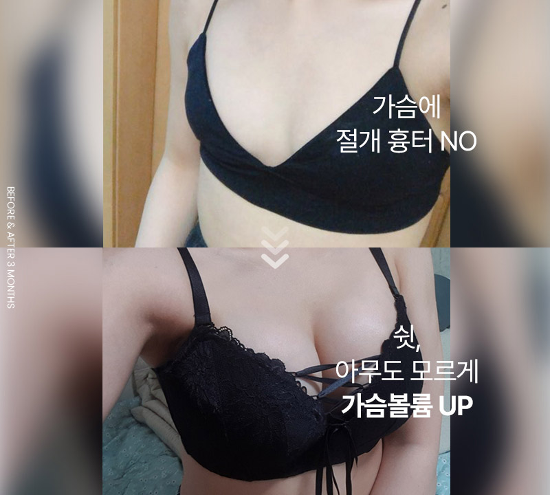가슴에 절개 흉터 NO. 쉿 아무도 모르게 가슴볼륨 UP