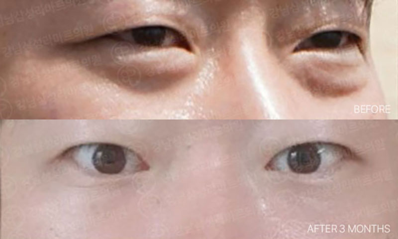 전후사진