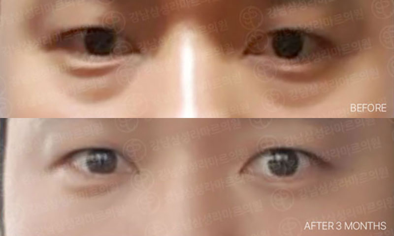 전후사진