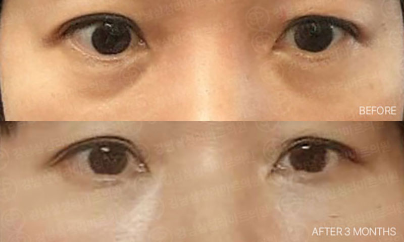 전후사진