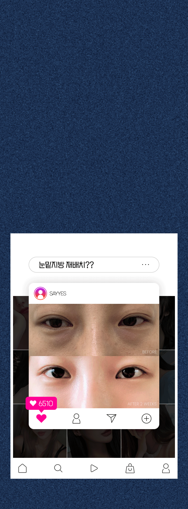 볼록하고 다크한 눈밑때문에 피곤해 보이고 나이들어 보인다면? 20분 완성! 눈밑지방재배치가 정답! 애교는 살아있고, 매끄러운 눈밑 라인 밝은 눈매 어려보이는 인상