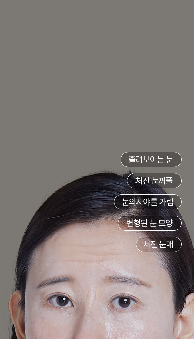 눈썹거상술로 생기있어 보이고 어려지는 눈매! + 노화로 인한 처진 눈꺼풀 + 변형된 눈 모양 + 심한 눈꺼풀 처짐으로 답답한 인상 한 번에 개선! 눈썹거상술