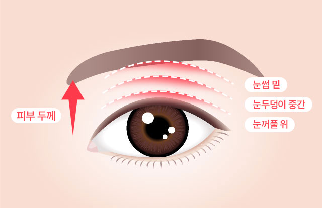 세이예스 눈썹거상술 세이예스는 피부두께와 처짐 정도를 정확히 파악하여 미적인 부분과 기능적인 부분 모두 개선 할 수 있는 수술법을 적용
