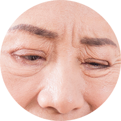 3 눈꺼풀이 심하게 늘어져 눈의 시야를 가리는 경우