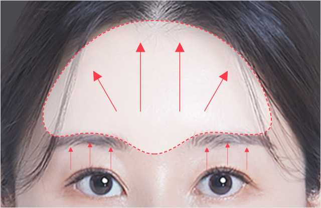 이마주름부터 미간주름, 눈가주름, 눈썹주름, 눈썹처짐 을 한번에 해결